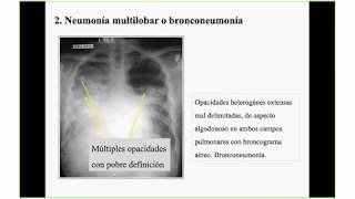 Videoconferencia INTERPRETACIÓN DE RADIOGRAFÍA DE TÓRAX EN NEUMONÍAS 17 de diciembre de 2018 [upl. by Ynahteb]