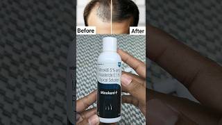 Minoxidil Hair Regrowth Results  Minoxidil Unboxing  minoxidil beard growth  minoxidil minokem f [upl. by Aehr]