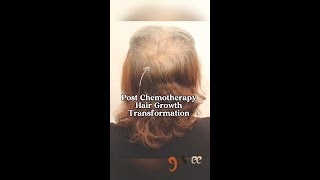 Hair Growth Post Chemotherapy [upl. by Hackett]