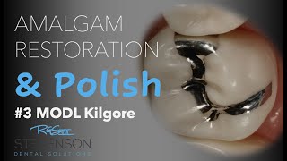 Amalgam Restoration and Polish 3 MOL Kilgore [upl. by Lantz]