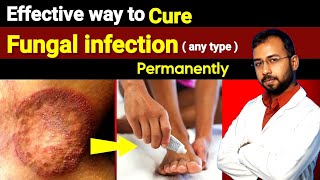 Best antifungal cream for fungal infection  ringworm  how to get ride of fungal infection [upl. by Noteek]