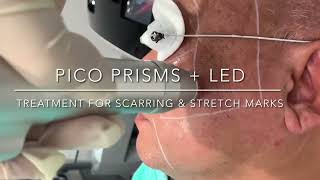 Pico Laser Treatment  Skincare Laser Clinic Point Cook [upl. by Burn6]