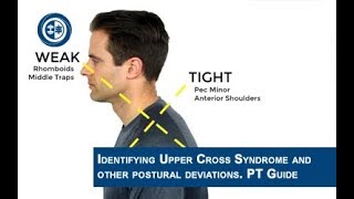 Upper Cross Syndrome and Lower Cross Syndrome for Personal Trainers [upl. by Tabina]