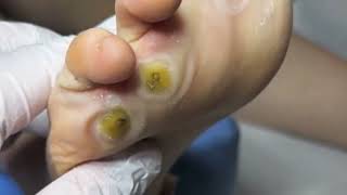 Pedicure video30，vertical plantaris，plantar wart [upl. by Ahsakal424]