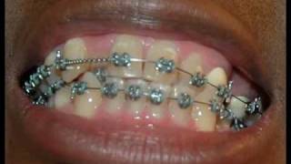 6 months 15 days in braces [upl. by Nugent]