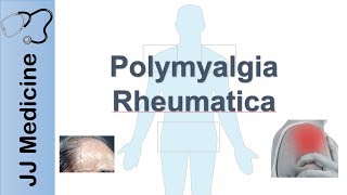 Polymyalgia Rheumatica  Signs amp Symptoms Diagnosis and Treatment [upl. by Yenruogis337]