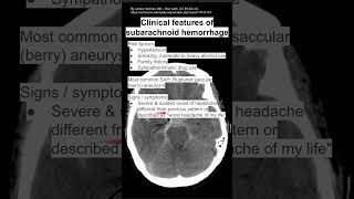 Clinical features of subarachnoid hemorrhage [upl. by Jovitah]