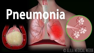 Pneumonia Animation [upl. by Eniagrom161]