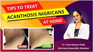 Dark Patch Acanthosis Nigricans Treatment by Dr Tanvi Mayur Patel [upl. by Notserk842]