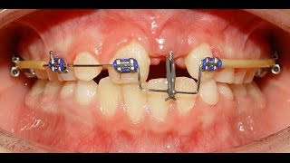 Orthodontic Treatment of an Impacted Dilacerated Upper Central Incisor  Alaa [upl. by Anaig]