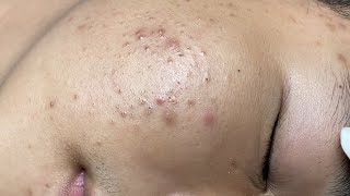 ACNE TREATMENT VU QUYNH MI Acne On Boys Chin 2024 [upl. by Franciska]