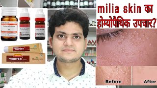 Milia Homeopathic medicine for Milia Milium Cyst Explain [upl. by Terza127]