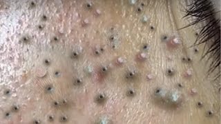 The Shocking Truth About Blackhead Removal Methods [upl. by True]