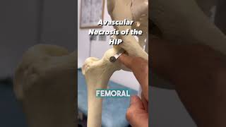 HOW DO YOU GET BONE NECROSIS OF THE HIP [upl. by Julita]