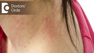 What does dry white itchy patch with redness indicateDr Rasya Dixit [upl. by Mcmath309]