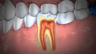 Treatment of Abscessed Teeth [upl. by Eggett]