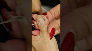 Toenail Ingrown Removal [upl. by Grissom]