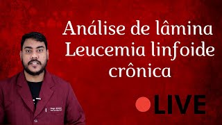 Leucemia linfoide crônica  Análise de lâmina [upl. by Uhn669]