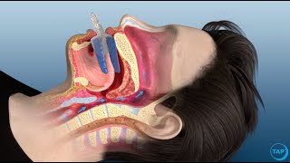 flexTAP Oral Appliance for Sleep Apnea How Does It Work [upl. by Melina815]