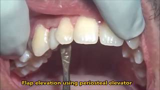 Extraction of retained milk tooth [upl. by Pitarys]