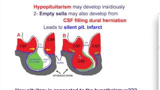 kallmann syndromeEmpty Sella syndrome [upl. by Aihsirt219]