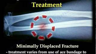 Nightstick Fracture  Ulnar Shaft fracture  Everything You Need To Know  Dr Nabil Ebraheim [upl. by Sibilla796]