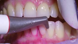 How teeth should be cleaned at the Dentist  Hygienist [upl. by Edric]