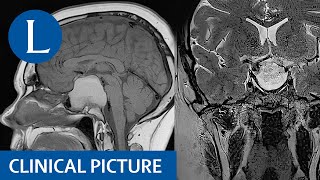 Pituitary apoplexy with a xanthogranuloma [upl. by Pilloff]