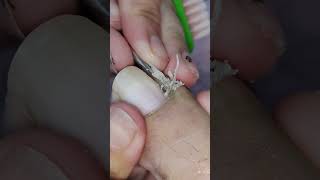 Toenail Ingrown Removal [upl. by Hara]