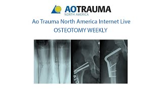 Osteotomy Week 7 May 30 Periarticular Osteotomies around the knee [upl. by Anelahs808]