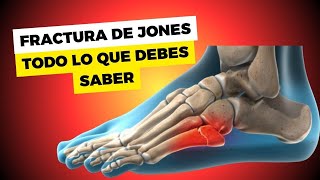 FRACTURA DE JONES QUINTO METATARSIANO TODO LO QUE DEBES SABER EN 2 MINUTOS [upl. by Vita682]