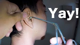 Something HUGE Stuck in Mans Ear for Weeks Finally Removed  What is It [upl. by Arthur]