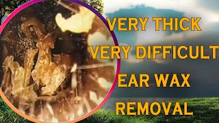 Very thick ear wax removal  Very difficult to removed  DR SEYLA [upl. by Faydra]