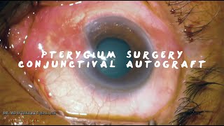 MIIQ 97 Pterygium Surgery Conjunctival Autograft with Sutures  DR MD IFTEKHER IQBAL RAJU [upl. by Falzetta]