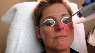 Nd YAG Laser Treatment for Rosacea at Total Body Care [upl. by Noirad]