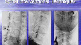 Radiology  Radiological Spine Interventions [upl. by Ahtamas]