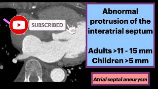 Atrial Septal Aneurysm Radiology Cardiology Cardiovascular [upl. by Abbotsun]