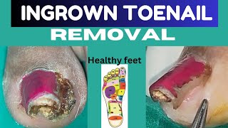 Ingrown toenail ingrown toenail treatment in Ranchi Best ingrown toenail surgery in Ranchi [upl. by Hedi]