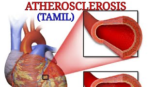 Atherosclerosis in tamil class medics [upl. by Baumbaugh]