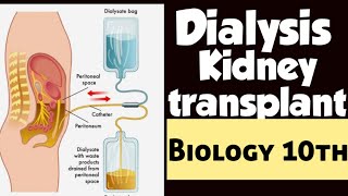 Dialysis Peritoneal dialysis and Haemodialysis  Kidney transplant  Biology 10th Chap 2  Lec 10 [upl. by Ali63]