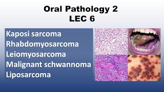 Oral Pathology 2  LEC 6 Kaposi sarcoma  Rhabdomyosarcoma  Leiomyosarcoma [upl. by Ainegue]