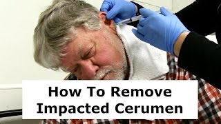 Removing Impacted Cerumen from a Patients Ear [upl. by Ubald]