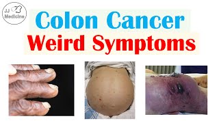 Colon Cancer Weird Symptoms amp Why They Occur [upl. by Whit653]