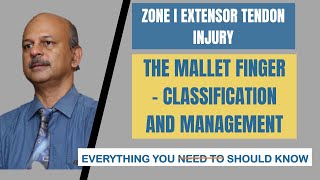 Zone I Extensor injury Mallet finger Everything you should know about it The splint the surgery [upl. by Dukey173]