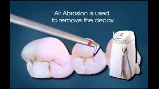 Air Abrasion  Miskin Ajax Dental [upl. by Festa993]