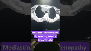 Mediastinal lymphadenopathy on CT scan pulmonary nodule on CT scan [upl. by Nickie45]