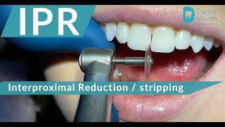 IPR 🪚🦷 Interproximal Reduction  stripping [upl. by Nanor]