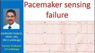 Pacemaker sensing failure [upl. by Maitland]