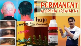 5 Best Homeopathic Medicine For Alopecia Areata Permanent Treatment  Regrow New Hair [upl. by Hurwitz]