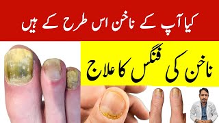 Nail Fungus Treatment Urdu Hindi  Irfan Azeem [upl. by Dogs]